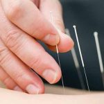 acupuncture